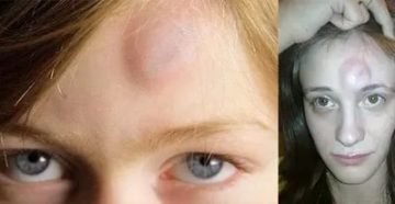 Пройдет ли онемение лба после удара? На лоб наложен шов Пройдет ли онемение лба после удара? На лоб наложен шов