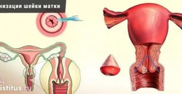 Можно ли родить после конизации шейки матки