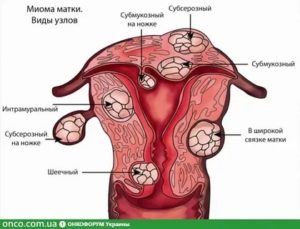 Субсерозная миома