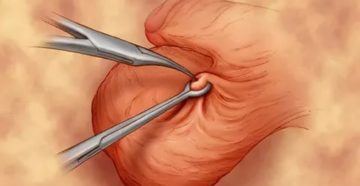 Вазэктомия и вазорезекция Вазэктомия и вазорезекция