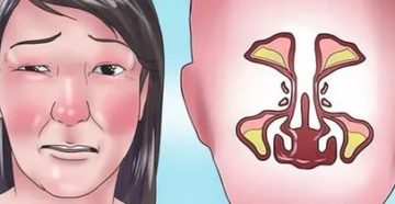 Припухлость щеки от синусита Припухлость щеки от синусита