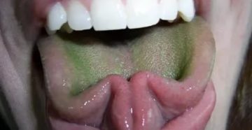 Налёт на небном язычке Налёт на небном язычке