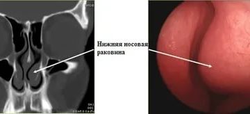 Элементы носовых раковин увеличение в объеме Элементы носовых раковин увеличение в объеме