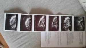 Положительный тест, узи не показывает