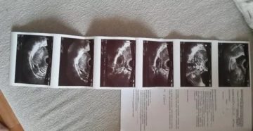 Положительный тест, узи не показывает