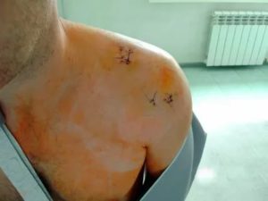 Ранение в плечо, задет сустав