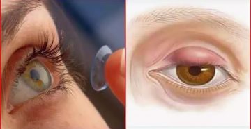 Линза ушла под веко