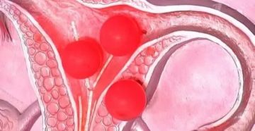 Кровотечение после пропуска ОК Медиана