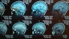 Расшифровка МРТ головного мозга