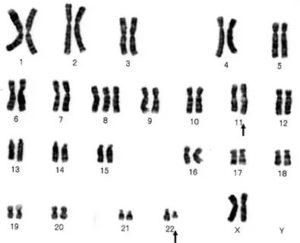Кариотип. Трисомия хромосомы 22