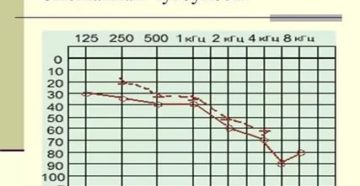 Двухсторонняя смешанная тугоухость 2 степени