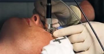 Осложнения после лазерной коррекции зрения методом LASIK