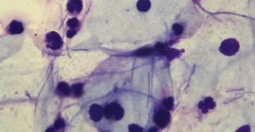 Лептотрикс при беременности