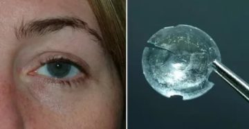 Пропала линза из глаза