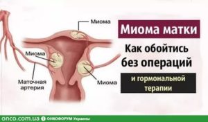 Поставили диагноз: миома матки. Отправляют на операцию. Нужен совет