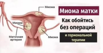 Поставили диагноз: миома матки. Отправляют на операцию. Нужен совет