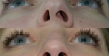 Назонекс после септопластики и вазотомии. Капать или нет? Назонекс после септопластики и вазотомии. Капать или нет?