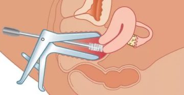 Мазок после родов