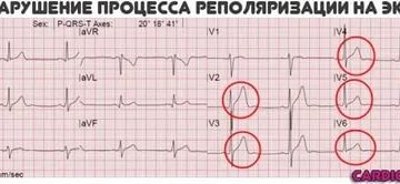 ЭКГ. Нарушение процессов реполяризации в миокарде ЛЖ