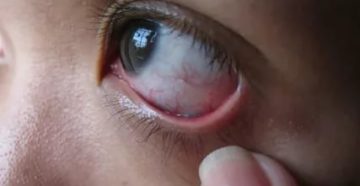 Боль в глазу! Лопнул шарик