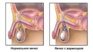 Немеет левое яичко