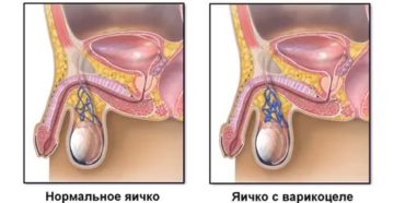 Немеет левое яичко Немеет левое яичко