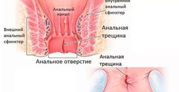 Появились боли в заднем проходе после свечек от геморроя