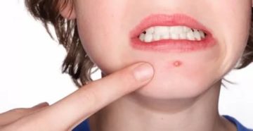 Фарингит, папилломы, герпес, стафилоккок Фарингит, папилломы, герпес, стафилоккок