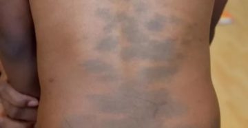 Пятно как синяк на спине с рождения