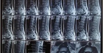 МРТ поясничного отдела