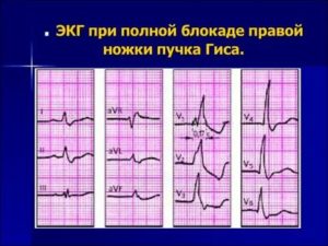 Блокада правой ножки пучка Гиса