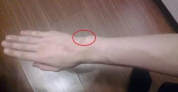 Болит косточка на кисти левой руки