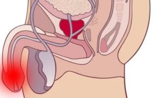 Простатит. Дискомфорт в члене
