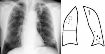 Причина образования Кальцината в S6 левого лёгкого