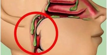 Налёт в горле, мокрота Налёт в горле, мокрота