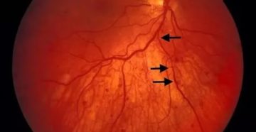 Изменение глазного дна Изменение глазного дна