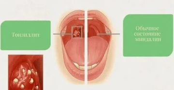 Больно глотать, болит горло и ухо Больно глотать, болит горло и ухо