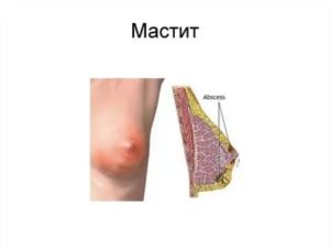 Прыщ на груди у кормящей мамы