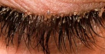 Демодекоз век