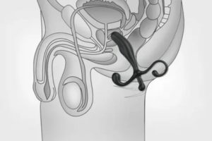 Нестабильность в эрекции и глубокое проникновение
