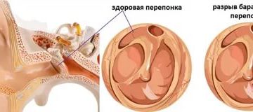 Как узнать не лопнула ли барабанная перепонка?