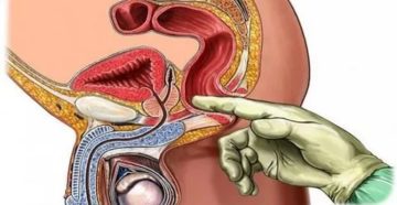 Простатит и мастурбация Простатит и мастурбация
