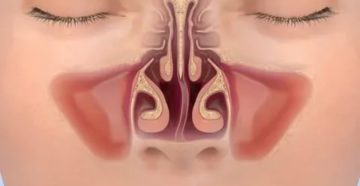 Заложенность носа при искривлении носовой перегородки