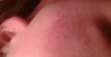 Странная сыпь на щеках и предплечьях ребенка, дерматолог не помог