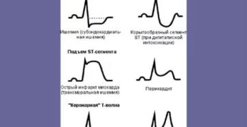 Элевация и депрессия сегмента ST