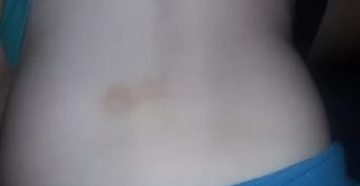 Пятно на пояснице у ребенка Пятно на пояснице у ребенка