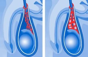Беспокоит темно-фиолетовая вена на левом яичке