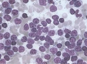 B-клеточный хронический лимфоцитарный лейкоз