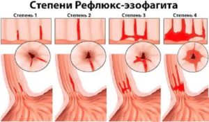 Лечение рефлюкс эзофагит 2 степени