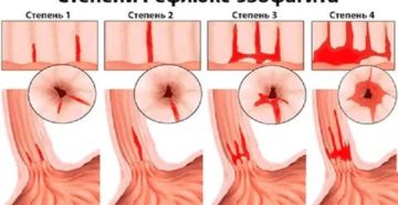 Лечение рефлюкс эзофагит 2 степени
